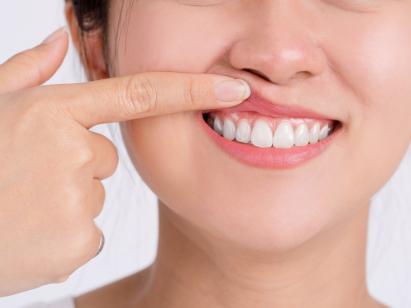 Wie unterscheiden sich Inlay und Onlay?