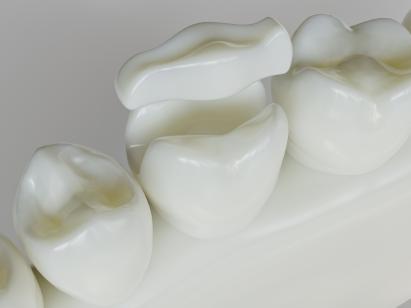 Wie unterscheiden sich Inlay und Onlay?