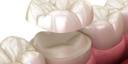 Zahnersatz bei Dr. Peter, Zahnarzt in Darmstadt